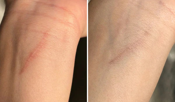 Luviva - Geavanceerde siliconen tape voor litteken- en rimpelbehandeling