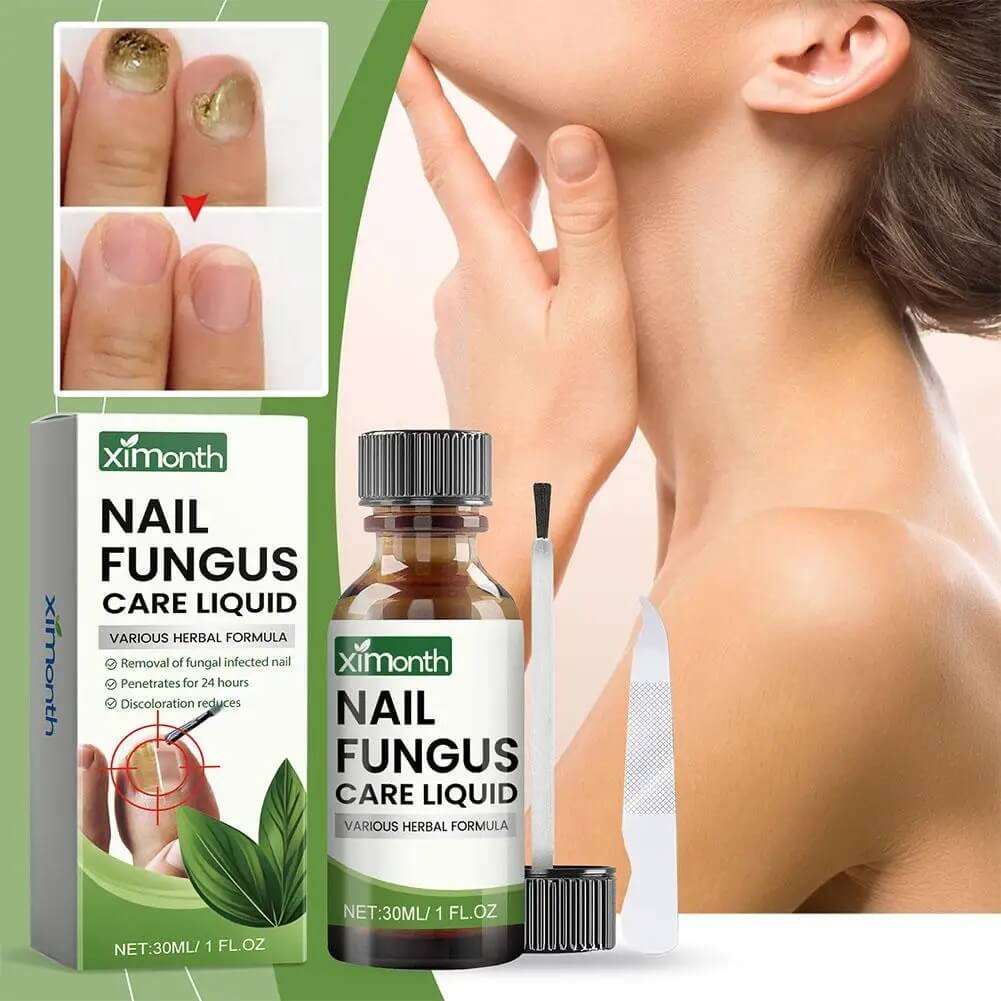 OnyFix - Behandeling van schimmelnagels en herstel van de nagelgezondheid